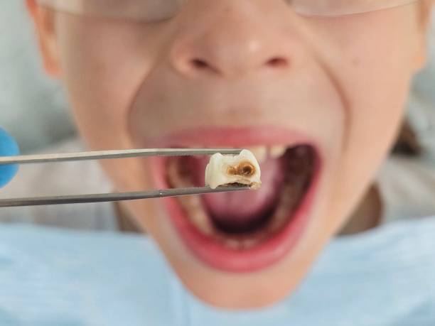 Best Emergency Root Canal Treatment in Avoca, PA